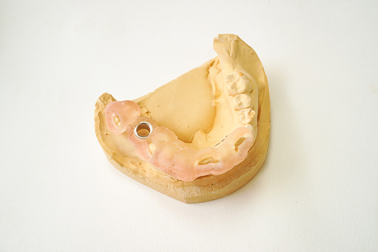 歯科用CTでお口のガイドを作り、精密なインプラント手術を実施
                
